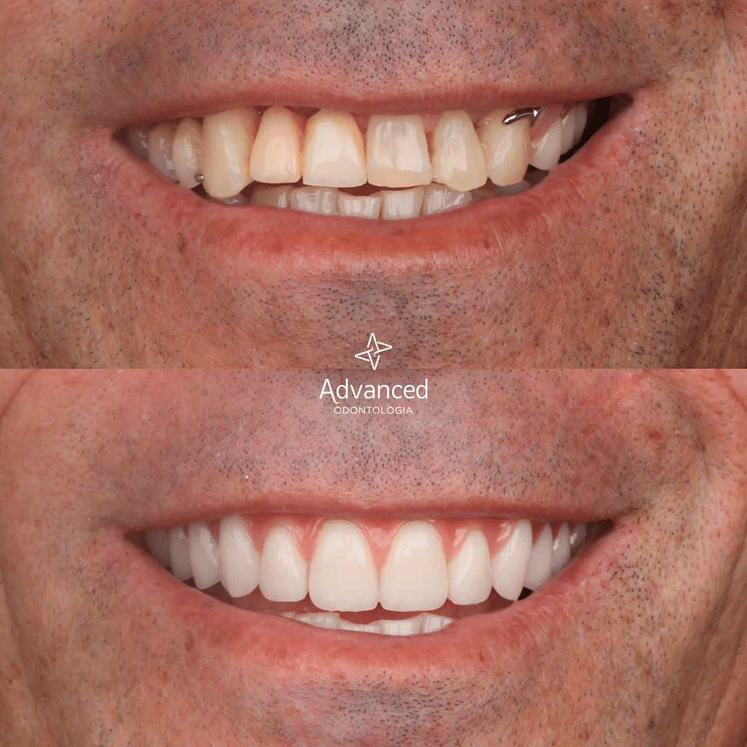 Antes e depois